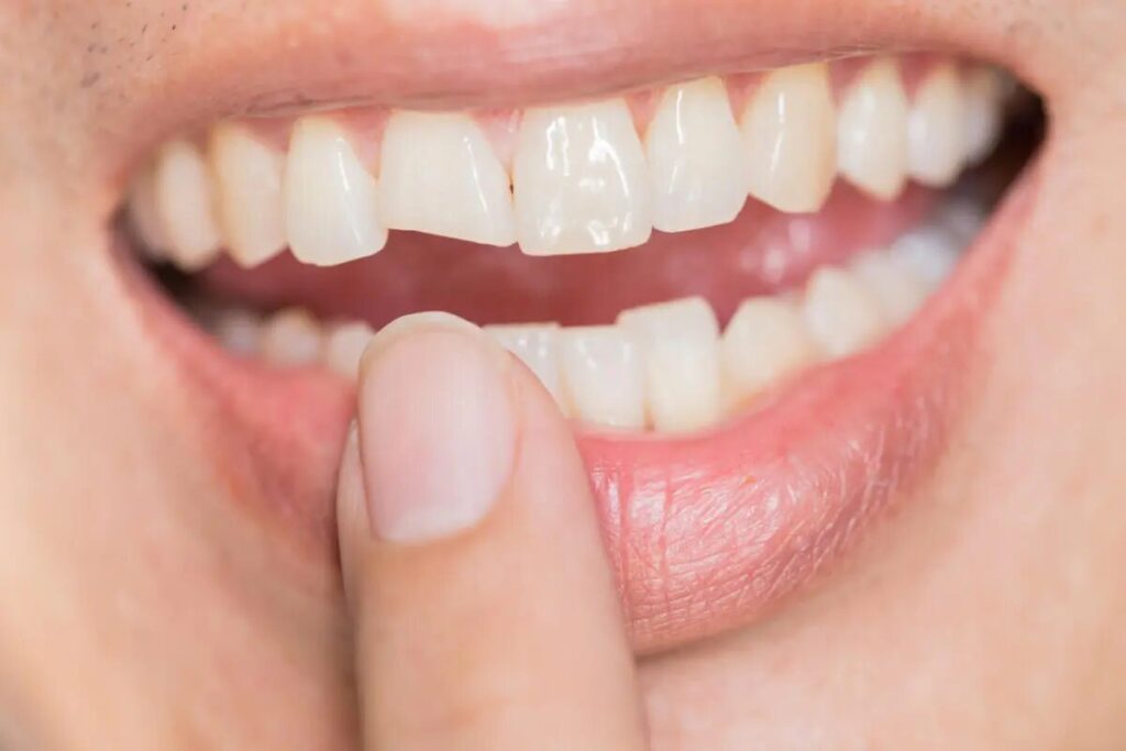 reimplante dental