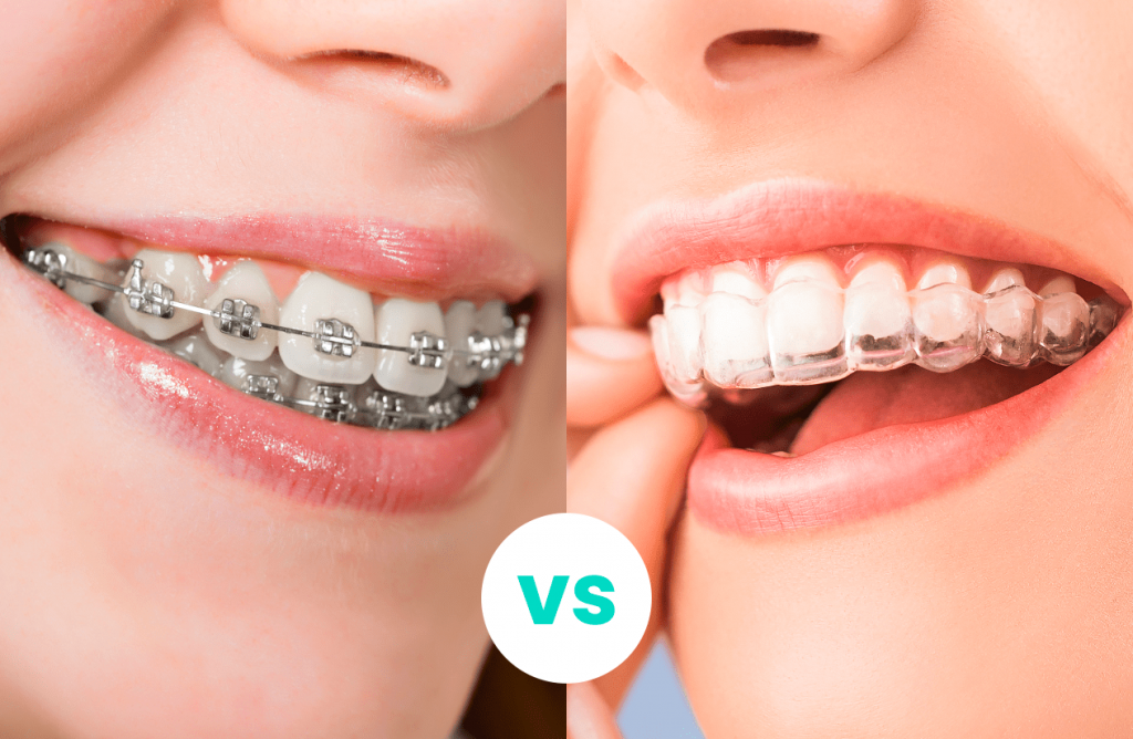 Alineación dental ortodoncia invisible y ortodoncia tradicional