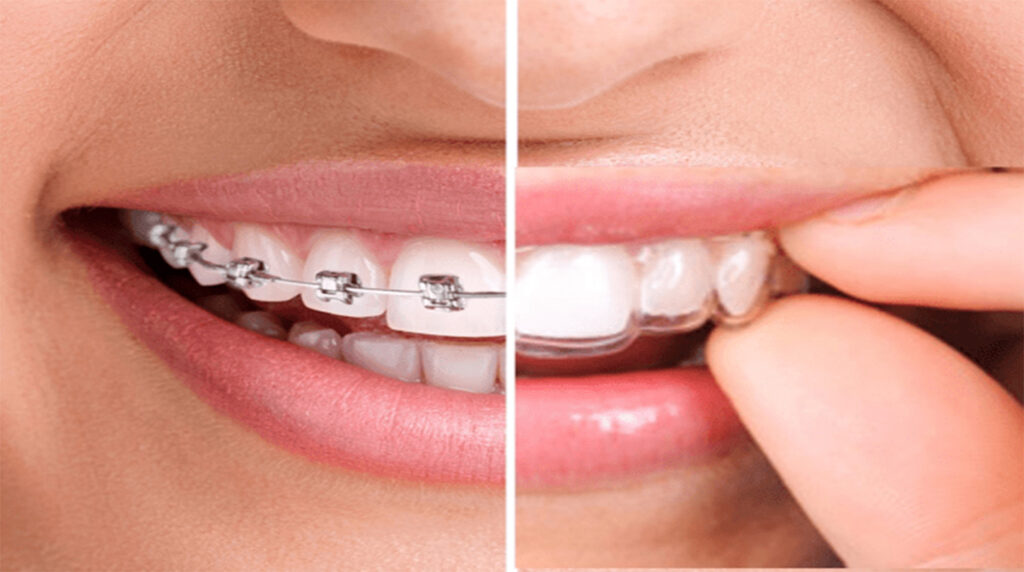 Alineación dental ortodoncia invisible y ortodoncia tradicional