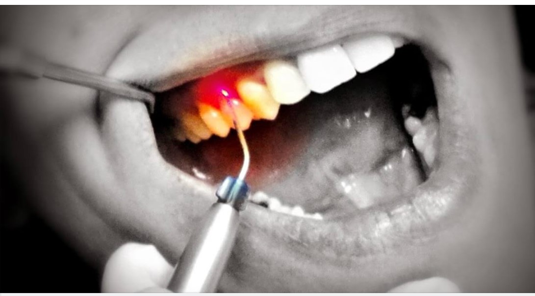 Láser no invasivo para tratamientos dentales