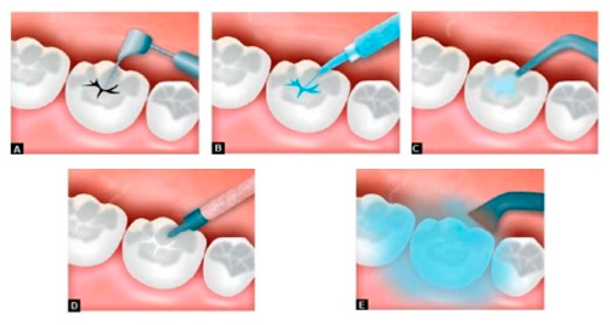 Cómo aplicar el sellado de fosas dentales en pacientes