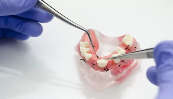 Diferentes técnicas de sutura en odontología y cuándo utilizar cada una