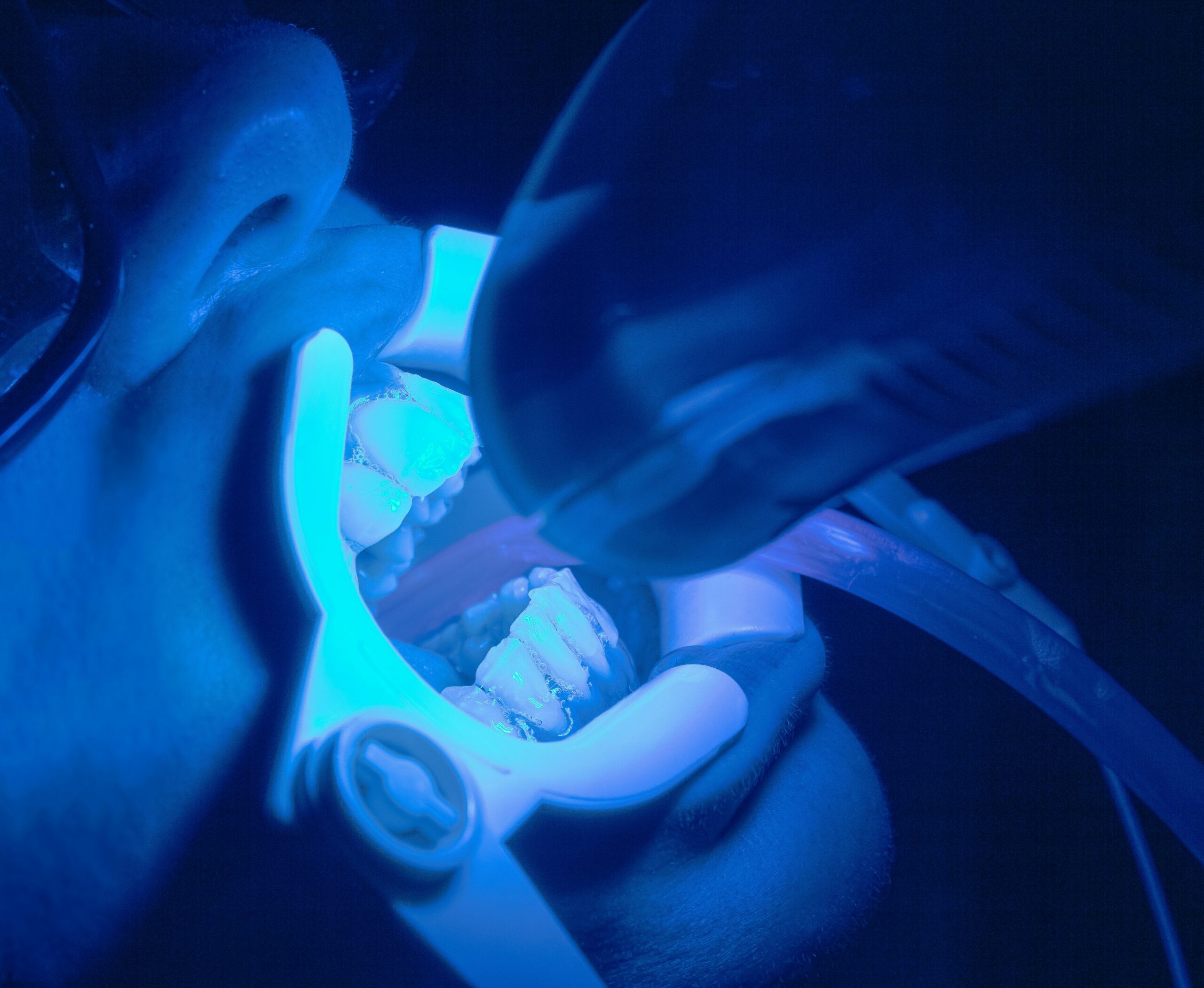 laser dental